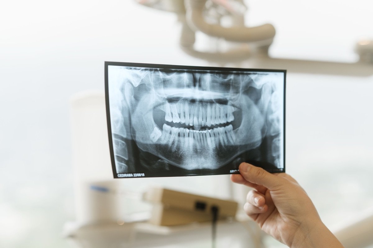 Radiografía dental usada para el diagnóstico